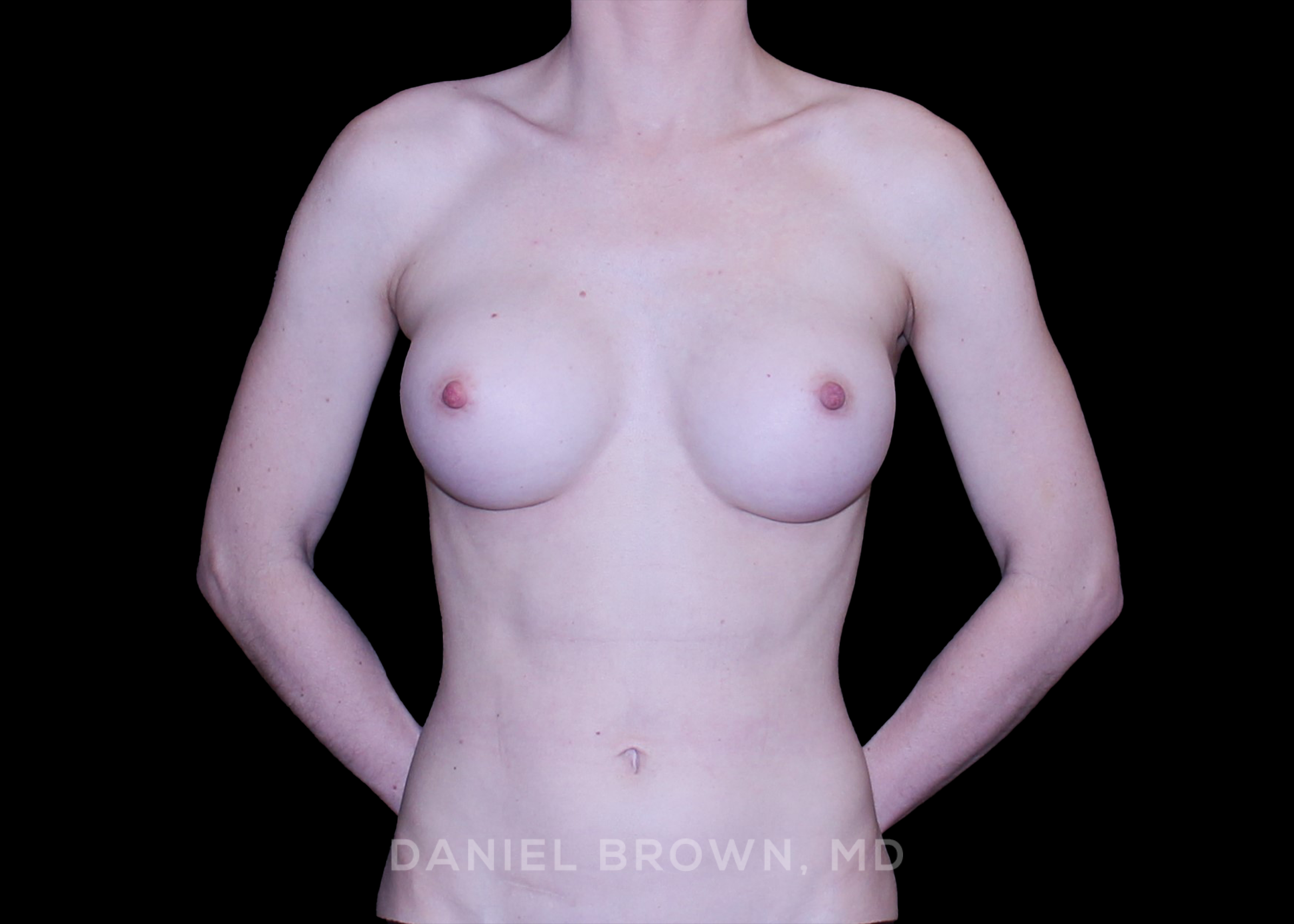 Breast Augmentation - Case 4340 - After