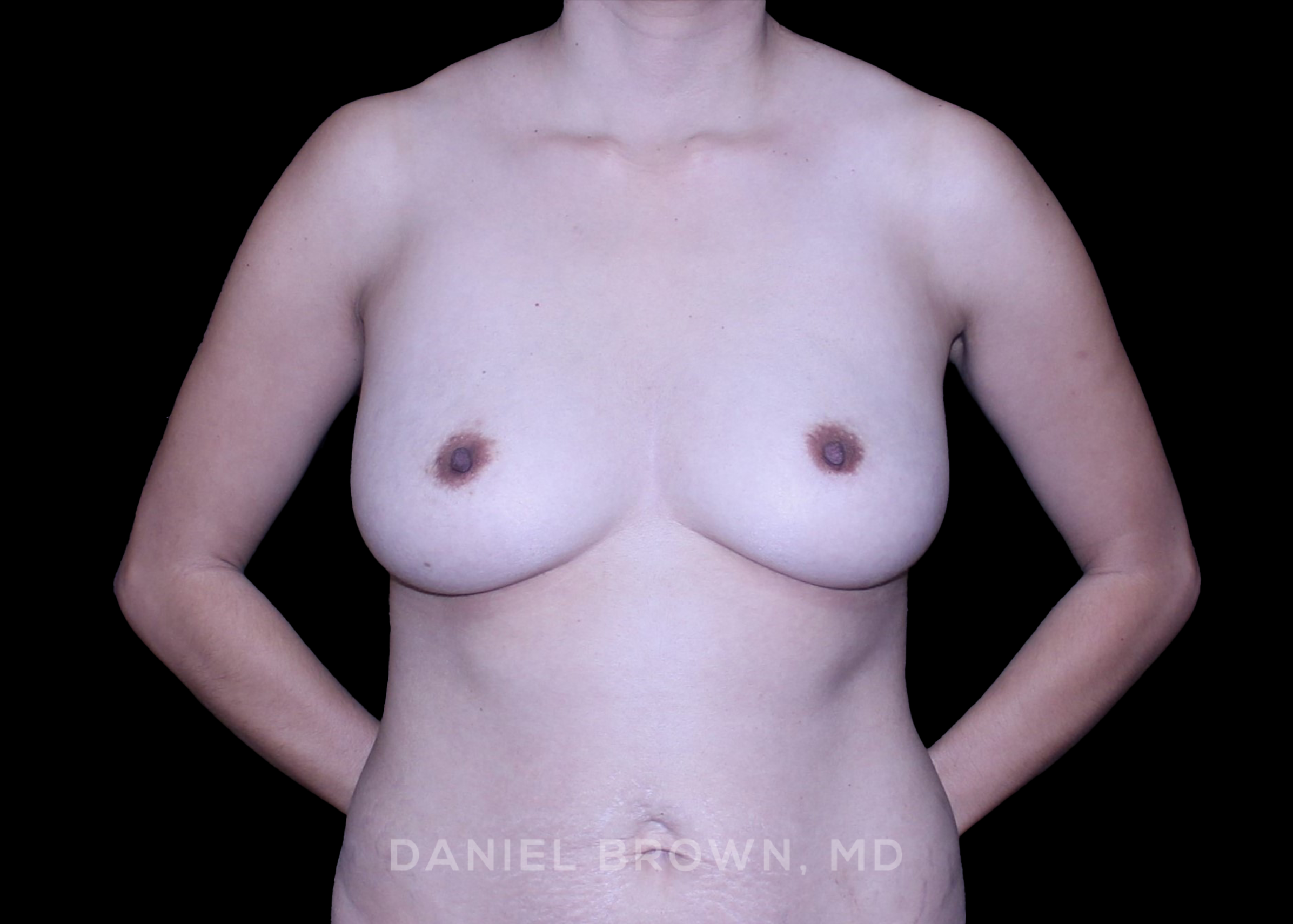 Breast Augmentation - Case 4351 - Before