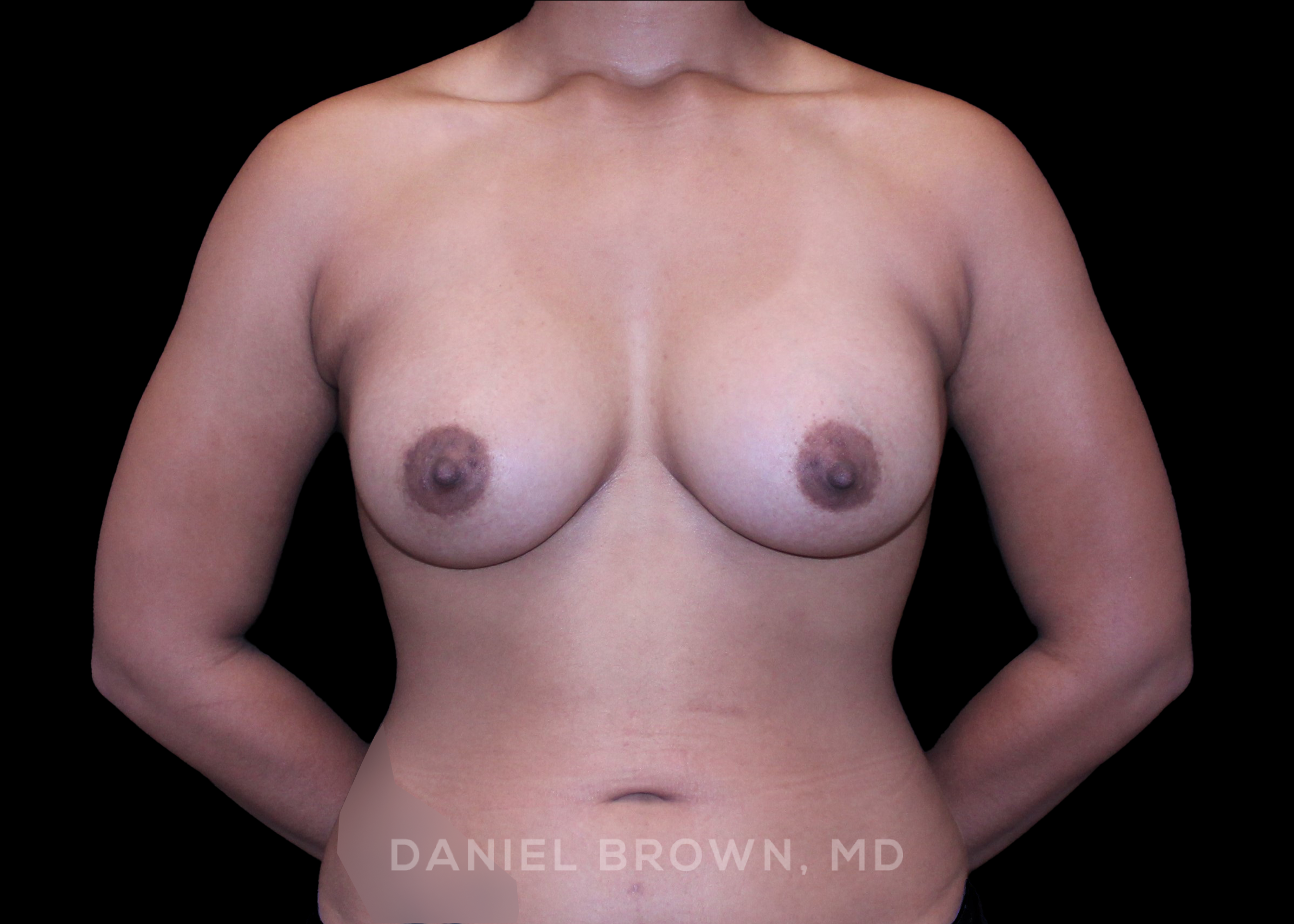 Breast Augmentation - Case 4362 - After