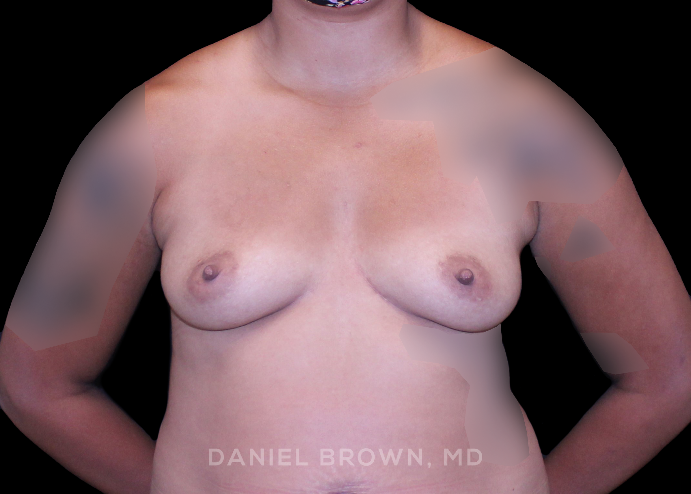 Breast Augmentation - Case 4202 - Before