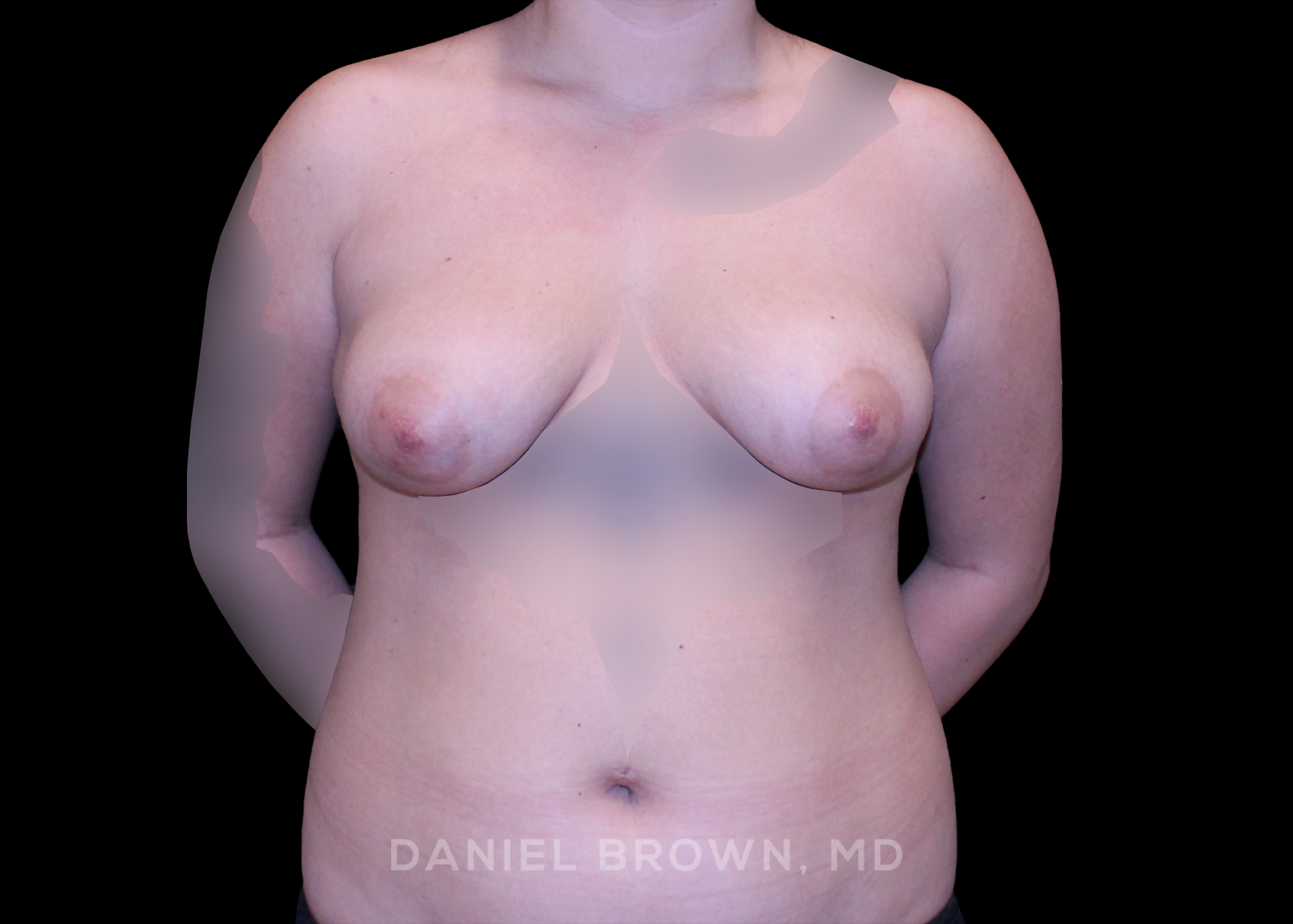 Breast Augmentation - Case 4259 - Before