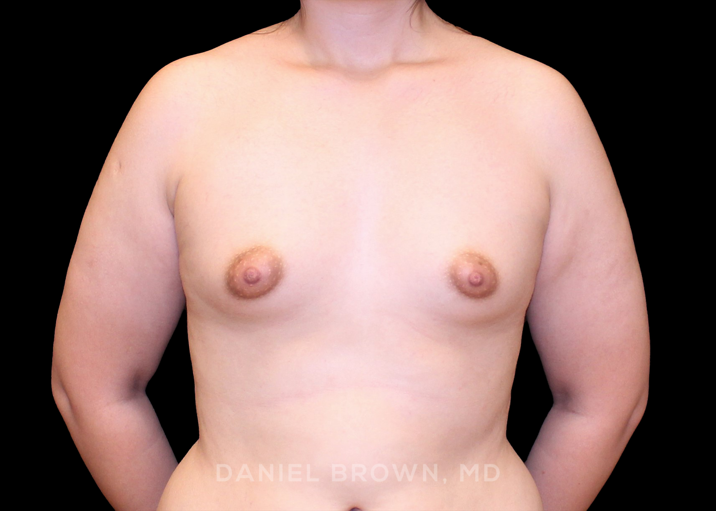 Breast Augmentation - Case 4331 - Before