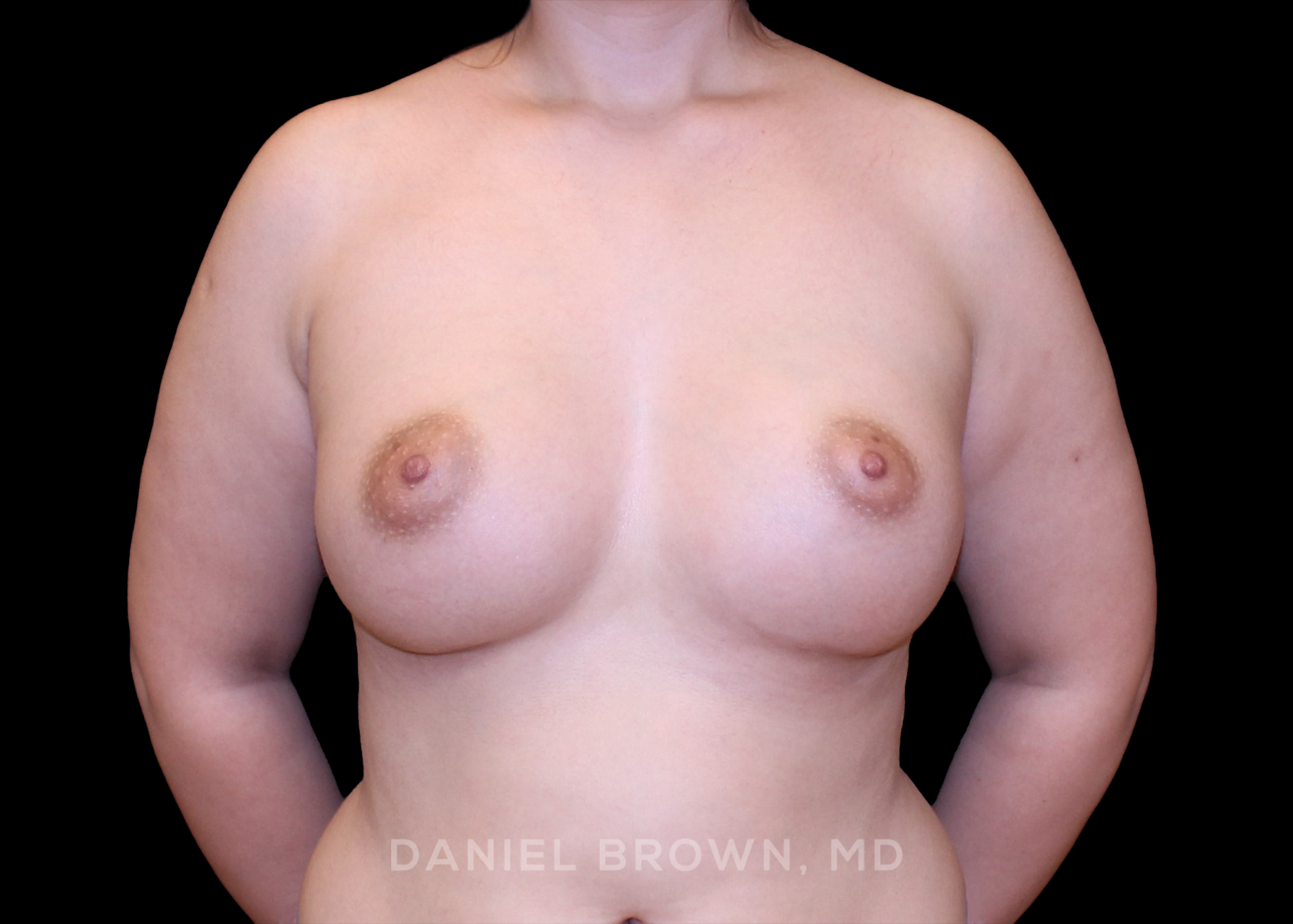Breast Augmentation - Case 4331 - After