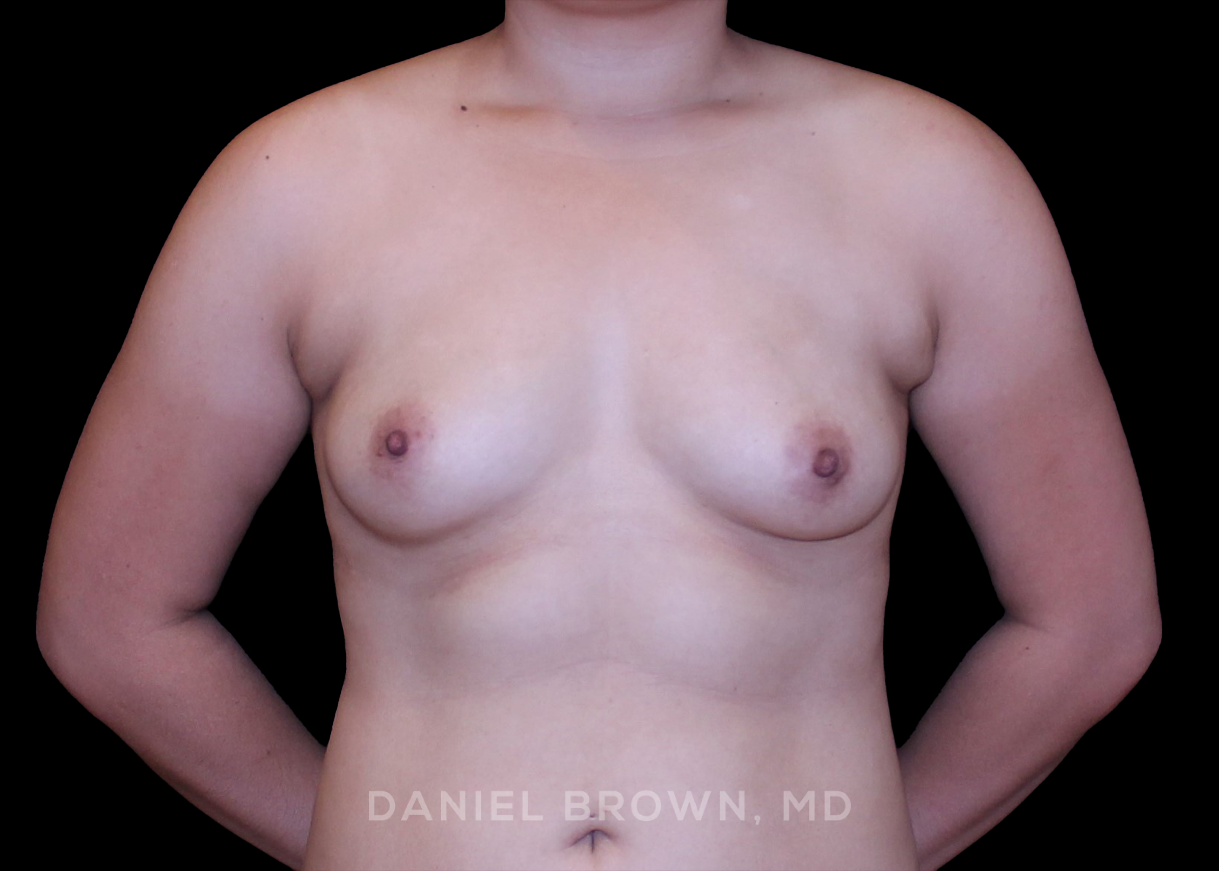 Breast Augmentation - Case 4338 - Before