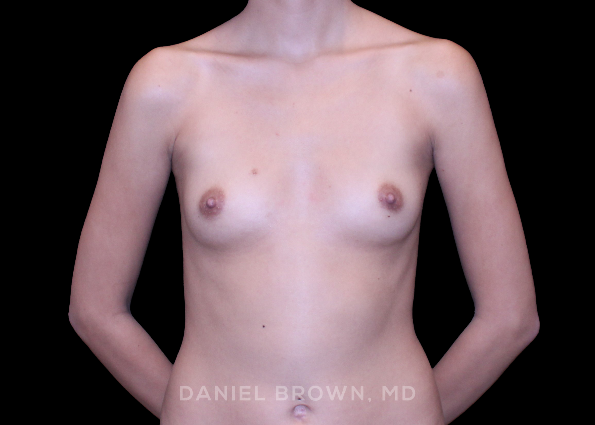 Breast Augmentation - Case 4358 - Before