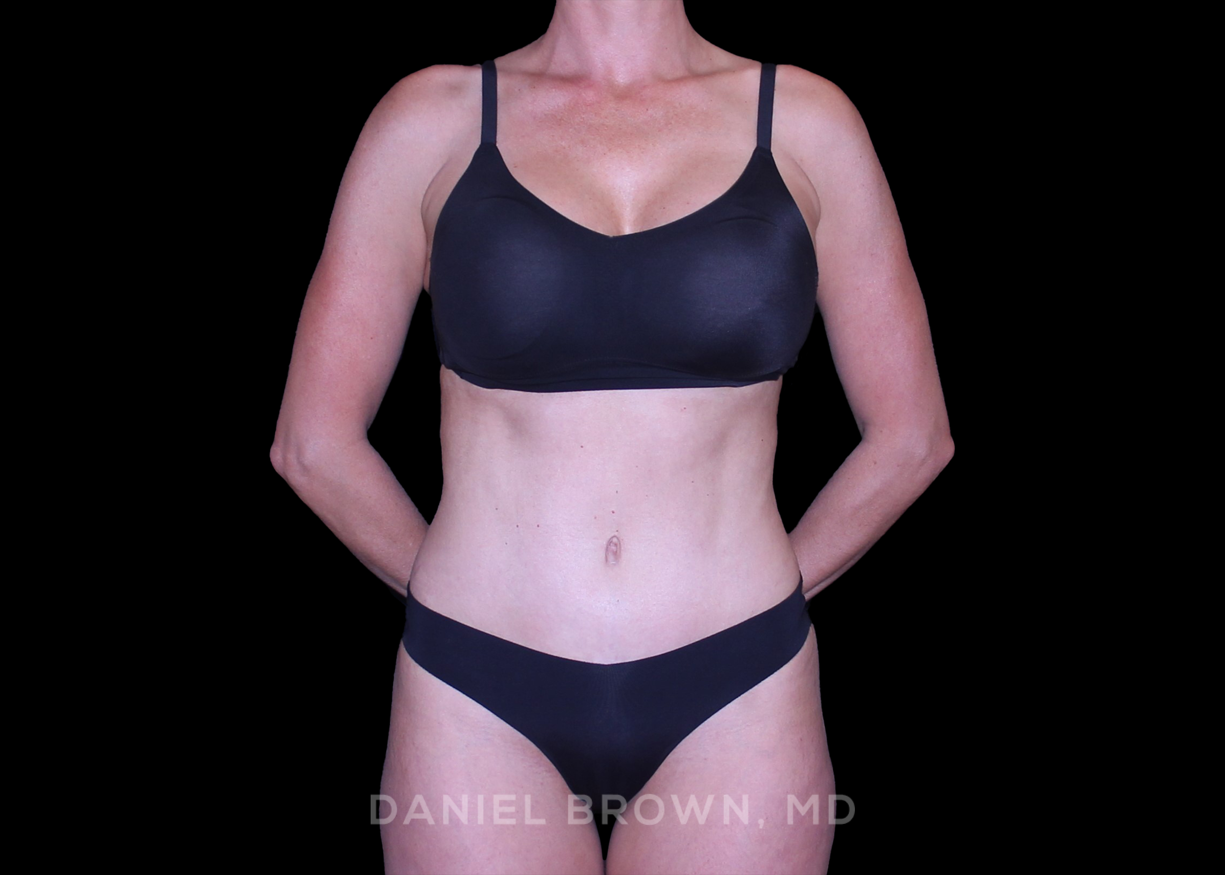 Tummy Tuck - Case 4573 - After