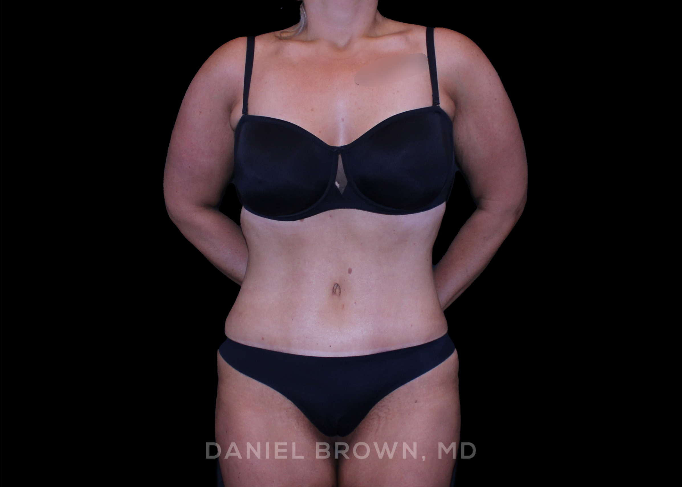 Tummy Tuck - Case 4621 - After