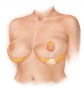 Bellesoma Breast Lift, Daniel Brown M.D