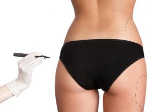 Contour Liposuction, Daniel Brown M.D