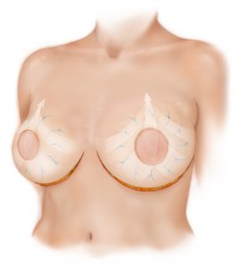 Bellesoma Breast Lift, Daniel Brown M.D