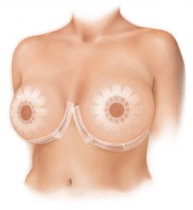 Bellesoma Breast Lift, Daniel Brown M.D