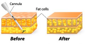 Contour Liposuction, Daniel Brown M.D