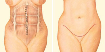 Tummy Tuck, Daniel Brown M.D