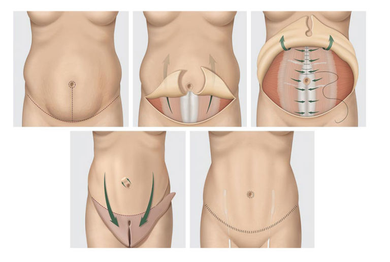 Tummy Tuck, Daniel Brown M.D