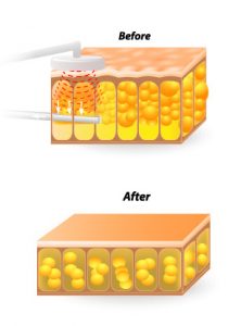 Contour Liposuction, Daniel Brown M.D