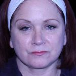 Blepharoplasty Before & After Patient #8643