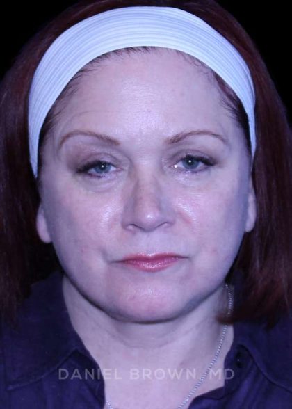 Blepharoplasty Before & After Patient #8643