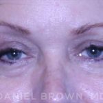 Blepharoplasty Before & After Patient #8643