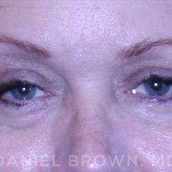 Blepharoplasty Before & After Patient #8643