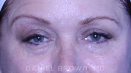 Blepharoplasty Before & After Patient #8643