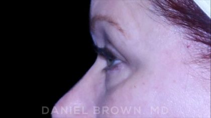 Blepharoplasty Before & After Patient #8643