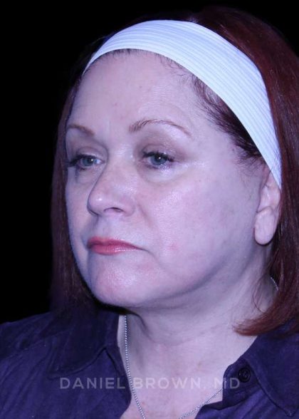 Blepharoplasty Before & After Patient #8643