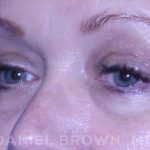 Blepharoplasty Before & After Patient #8643