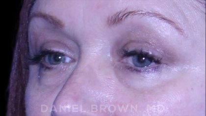 Blepharoplasty Before & After Patient #8643