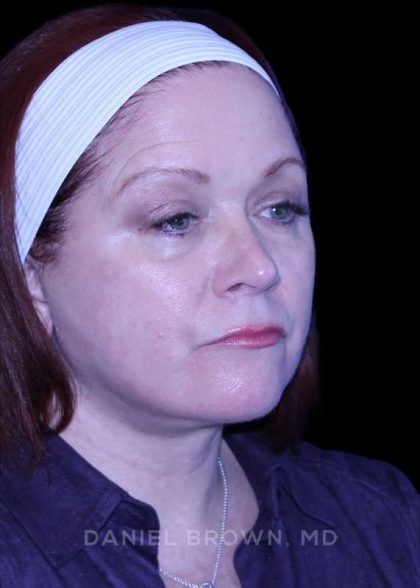 Blepharoplasty Before & After Patient #8643