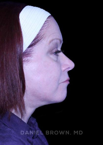 Blepharoplasty Before & After Patient #8643
