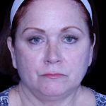 Blepharoplasty Before & After Patient #8643