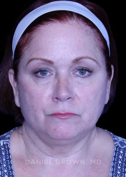 Blepharoplasty Before & After Patient #8643