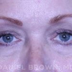 Blepharoplasty Before & After Patient #8643