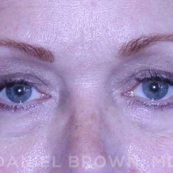 Blepharoplasty Before & After Patient #8643