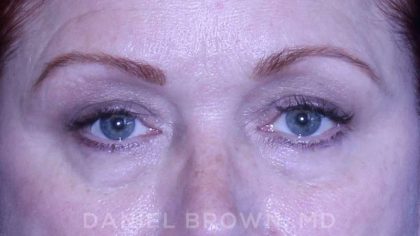 Blepharoplasty Before & After Patient #8643