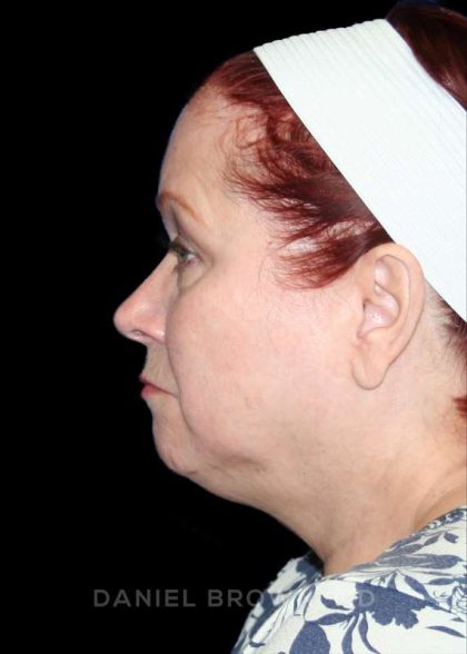 Blepharoplasty Before & After Patient #8643