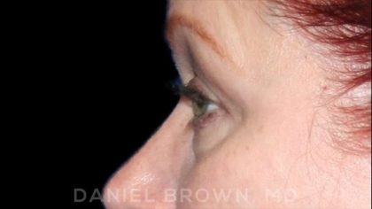 Blepharoplasty Before & After Patient #8643