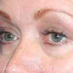 Blepharoplasty Before & After Patient #8643