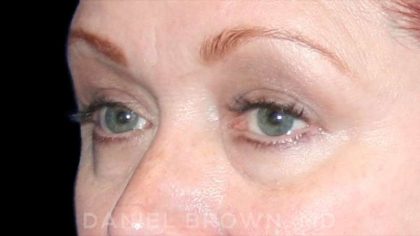 Blepharoplasty Before & After Patient #8643