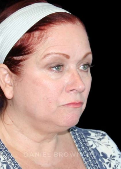Blepharoplasty Before & After Patient #8643