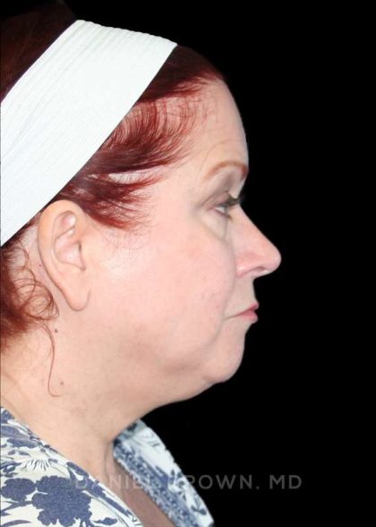 Blepharoplasty Before & After Patient #8643