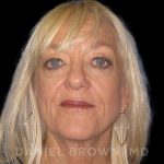 Blepharoplasty Before & After Patient #8648