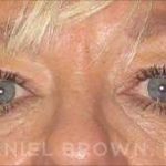 Blepharoplasty Before & After Patient #8648