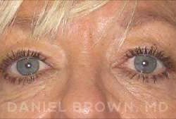 Blepharoplasty Before & After Patient #8648