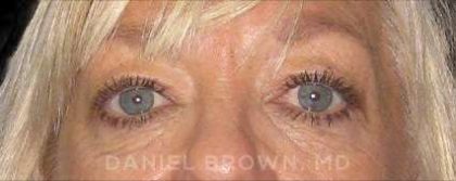 Blepharoplasty Before & After Patient #8648