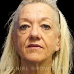 Blepharoplasty Before & After Patient #8648