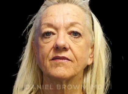 Blepharoplasty Before & After Patient #8648