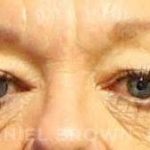 Blepharoplasty Before & After Patient #8648