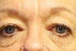 Blepharoplasty Before & After Patient #8648