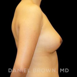 Breast Lift Before & After Patient #9502
